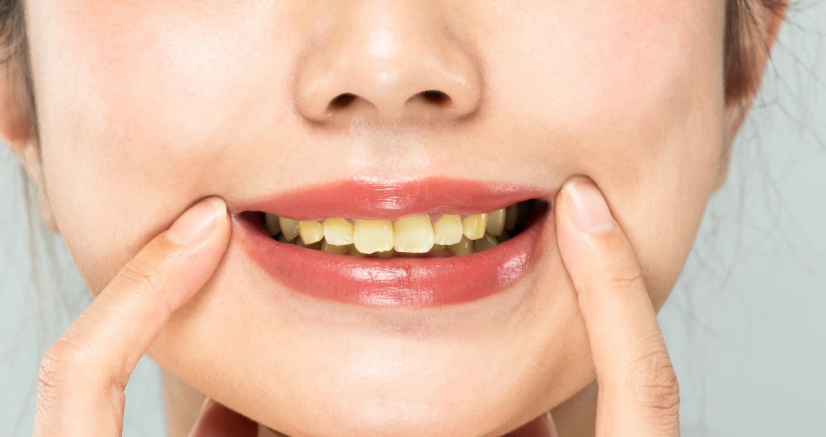 歯を白くする方法や裏ワザまとめ！セルフでできて歯の黄ばみスッキリ！